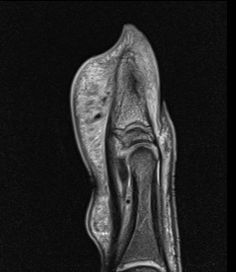 Figure 4 for case Osteoid osteoma ( RID4005 )